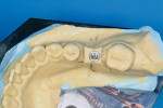 Figure 3  Implant analog has been placed into the cast osteotomy.
