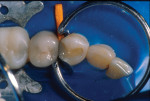 Figure 4. The flowable composite resin was
light-cured after the resin-modified glass ionomer
and adhesive resin were placed.