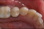 Figure 9. The final esthetic restorative outcome
demonstrates imperceptible blending with the
natural tooth structure.