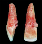 Fig 6. The removed tooth showed the internal resorption lesion had perforated the palatal aspect of the root.