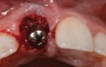 Fig 11. The provisional was removed after contour verification, and a tall, flat-contoured titanium healing abutment was placed to allow access to the labial gap and the condensation of bone allograft material using the dual-zone technique
