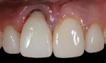 Fig 12. The provisional restoration was replaced after dual-zone grafting to contain and protect the material during the healing phase. Note the facial gingival undercontouring, or proper contouring relative to the corrected implant location, versus the labial malposition of the existing tooth.