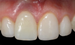 Fig 13. The undercontoured provisional restoration allowed the peri-implant soft tissues to collapse and migrate incisally to a normal free gingival margin position after 3 weeks of healing.