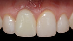 Fig 14. The hard and soft tissues were given 5 months to heal before first abutment disconnection for final impression making. The level of the midfacial free gingival margin was re-established and stable.