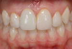 Fig 19. Intraoral view of the inserted definitive crown in maximum intercuspal position. The level of the free gingival margin was corrected equivalent to and harmonious with the adjacent dentition.