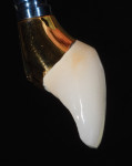 Fig 18. The screw-retained metal-ceramic noble alloy crown was gold-plated to improve the color tone of the peri-implant soft tissues.