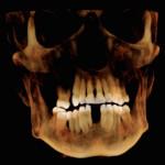 Fig 5. CBCT rendition of maxilla and mandible indicating extent of bone resorption.