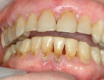 Figure 2  Caries progression of a patient with severe saliva hypofunction due to Sjögren’s syndrome.