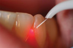 Figure 2  The newest technology has many advantageous features that facilitate treatment of periodontal diseases and other soft tissue applications.