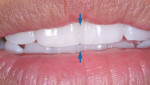 Fig 1 and Fig 2. December 2002: Jaw tracking system and instrumentation implemented. Note the occlusal conditions and the integrity of the incisal borders before degeneration.