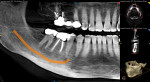 CBCT image obtained for diagnosis and treatment planning.
