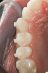 Figure 4  The preoperative condition displays only a mild rotation of tooth No. 13 and ample access to the contact from an occlusal approach.