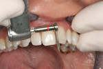 Figure 11  Position the disc against tooth No. 8 and with a sweeping, pushing motion, begin reduction of the mesial enamel.