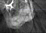 CBCT scan sectioned through buccal root showing a single canal present.