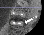 CBCT scan with a vertical root fracture noted on the distal root.