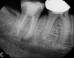 Historical 7-month reevaluation showing newly developed periapical radiolucencies on both teeth.