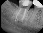 Postoperative image of tooth No. 31 following retreatment.