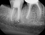 Postoperative image of tooth No. 30 following retreatment and placement of the permanent restoration in both No. 30 and No. 31.