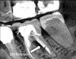 CBCT image showing strip perforation from post placement on the furcation side of the distal root