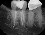 A postoperative radiograph showing extruded sealer potentially tracking the length of the mandibular canal. An immediate Postoperative CBCT scan was taken in order to ascertain the location of the sealer and its proximity to the inferior alveolar nerve. The sealer was positioned lingual to the nerve; the patient reported no symptoms at the followup
appointment.