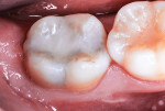 Class I restoration completed after SDF swabbing of tooth preparation 3 months prior.