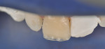 Composites in the colors Opaque White and
Enamel Trans are placed along the incisal edge, mimicking the information-rich incisal region of younger patients.