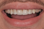 Integration between restoration and natural tooth structures resulting in a more harmonic smile.