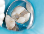 Figure 1  After the cavity was cleaned thoroughly, an ultra-fine diamond dental strip was inserted into the interproximal space followed by the insertion of the inlay body into the preparation.