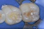 Fig 1. Pretreatment condition. Note minimal sign of caries at the distal pit of the occlusal surface.