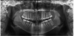 Fig 2. DBI seen on the mandibular left second molar.