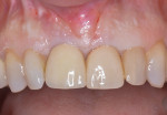After nonsurgical debridement and systemic antibiotics, the patient returns for surgical
therapy. Pre-existing gingival levels and esthetics, which have been stable for almost 8 years,
are present.