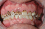 Figure 7  Preoperative condition shows severe destruction of the maxillary teeth.