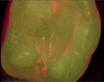 Figure 1  Detection mode shows healthy tooth structure as green and questionable areas as red.