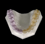 Figure 2  E4D Dentist can mill all-ceramic restoratives.