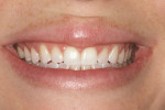 Figure 7  The preoperative smile shows small teeth surrounded by the large frame of the full lips.