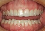 Figure 9  A 48-hour postoperative photograph demonstrates teeth that are larger and more symmetrical.