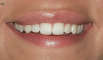 Figure 11  The preoperative smile shows dominant central incisors and deep incisal embrasures that created a rounded appearance to the teeth and a slightly uneven smile line.