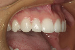 Figure 14  The 2-week postoperative photograph demonstrates an excellent esthetic blend of the no-prep veneers and the natural teeth.