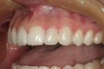 Figure 15  The 2-week postoperative photograph shows excellent soft tissue response to the new veneers.