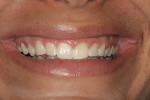 Figure 18  Preoperative full smile demonstrating excessive gingival display, short uneven teeth, and negative space in the buccal corridor.