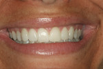 Figure 22  The postoperative smile shows a decrease in the amount of gingival display, a slight filling of the buccal corridor, and a more symmetrical smile.