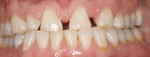 Figure 1  Patient demonstrates a diastema, midline discrepancy, congenitally missing left lateral incisor and worn incisal edges.