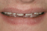 Figure 3  In the casual smile, there was 1 mm of incisor display.