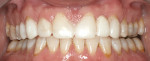 Figure 10  Retracted view of Bis-acryl try-in for patient to perceive the esthetic potential prior to initiating treatment.