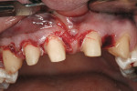 Figure 12  Periodontal surgery for crown lengthening and ovate pontic formation.