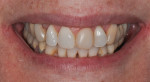 Fig 1. Preoperative condition demonstrating deficient buccal corridors, poor gingival margin contours, and unattractive shades, shapes, and tooth positions.