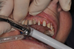 Fig 6. Preparation of the provisionals intraorally without changing the subgingival substructure.