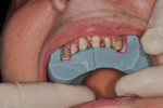 Fig 8. Two of the three segments being tried into the mouth to confirm passive fit. Note the substantial thickness of the putty.