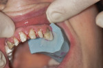 Fig 11. Placement of the filled segment into the mouth.