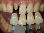 Figure 6  Using the Classical Shade Guide arranged by value and working by a process of elimination to get to four tabs that cover the value range of the tooth being evaluated.